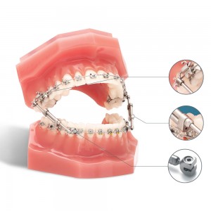 Bite corrector TruEase Εξαρτήματα-Attachments